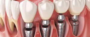 EMC - Esthetic Medical-Dental Corporation - Implantes Dentários e a sua Importância na Saúde Oral